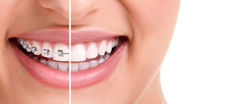 4 Ways to Restore Stained Teeth From Braces