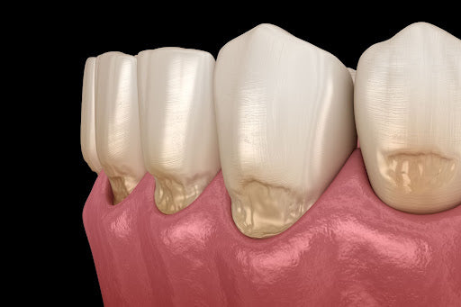 Understanding Abfraction Teeth: Causes, Symptoms, and Treatment Options