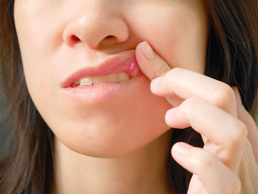 Canker Sores and Stress: Understanding the Connection
