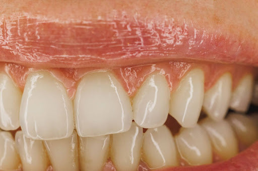 Can You Actually Stop Gum Recession?