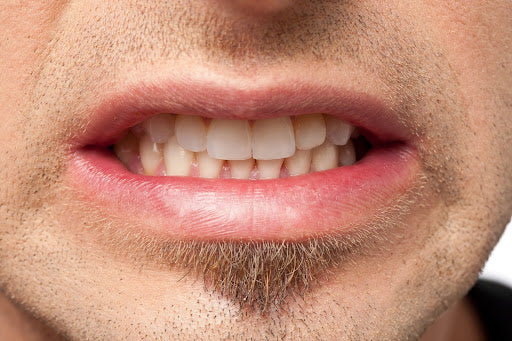 How to Treat Bruxism: 5 Helpful Tips