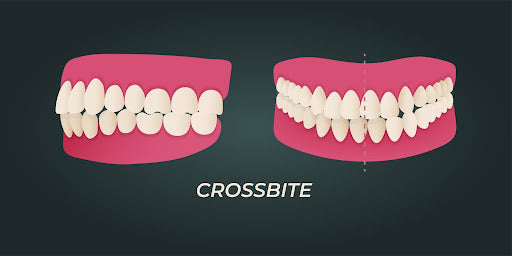 Jaw Misalignment: Signs + How to Maximize Comfort