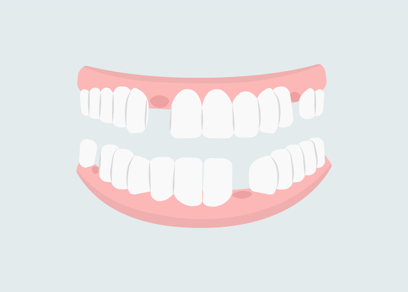 Can I Wear a Night Guard if I Have Missing Teeth or Dentures?