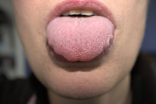 Scalloped Tongue: What It Is and How to Treat It