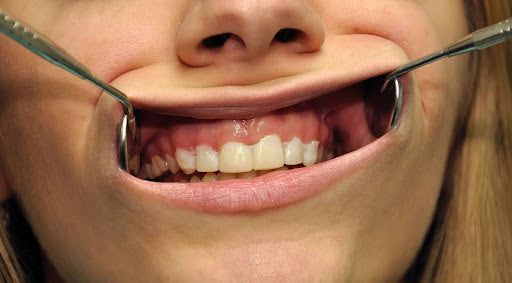 What Causes Wear Facets (and How Do You Treat Them)?