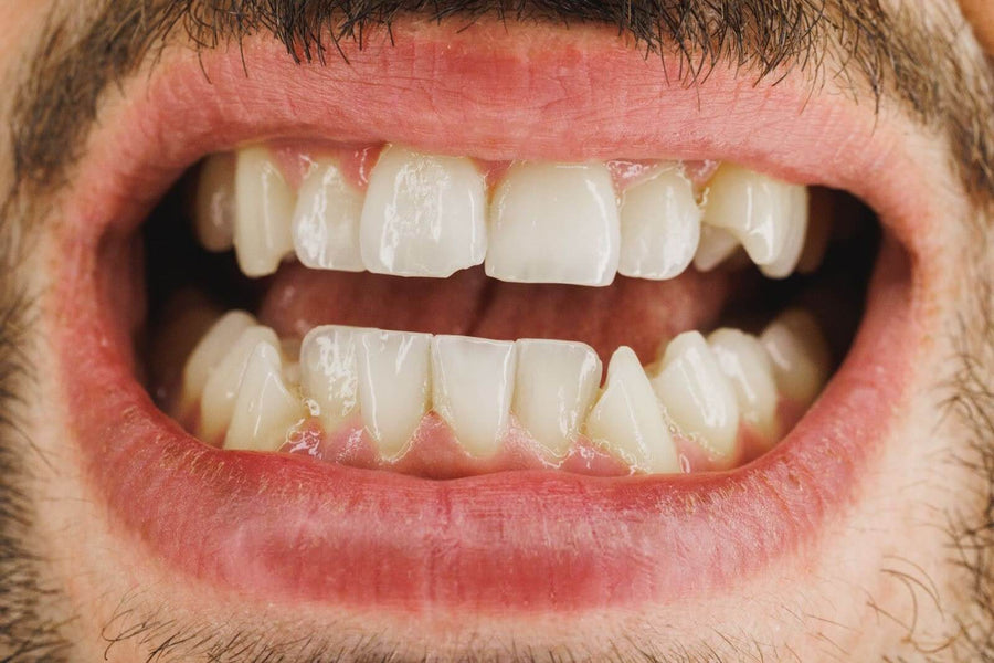 What to Do About Worn Down Teeth